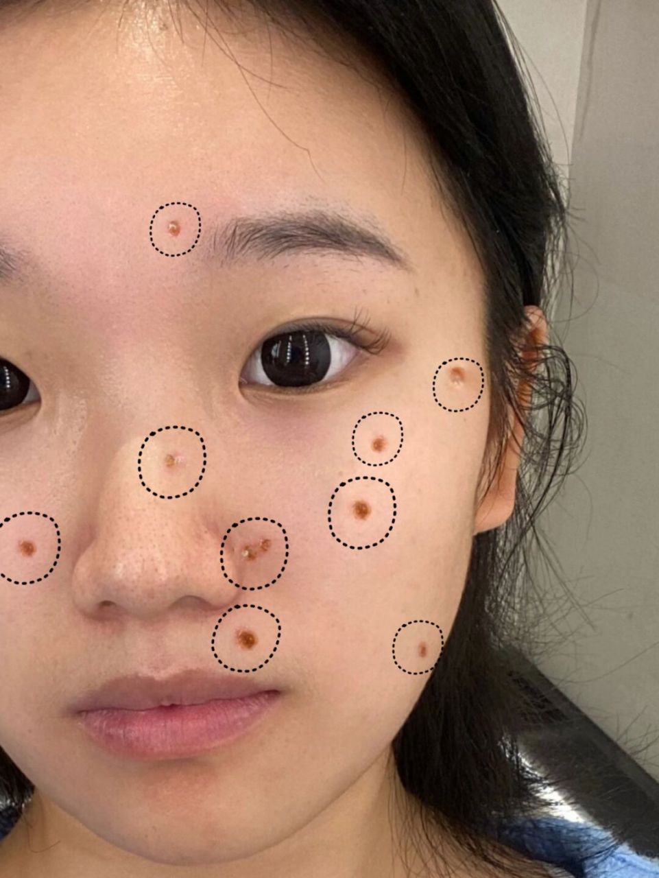 能劝一个是一个 跪求点痣的姐妹去皮肤科吧!