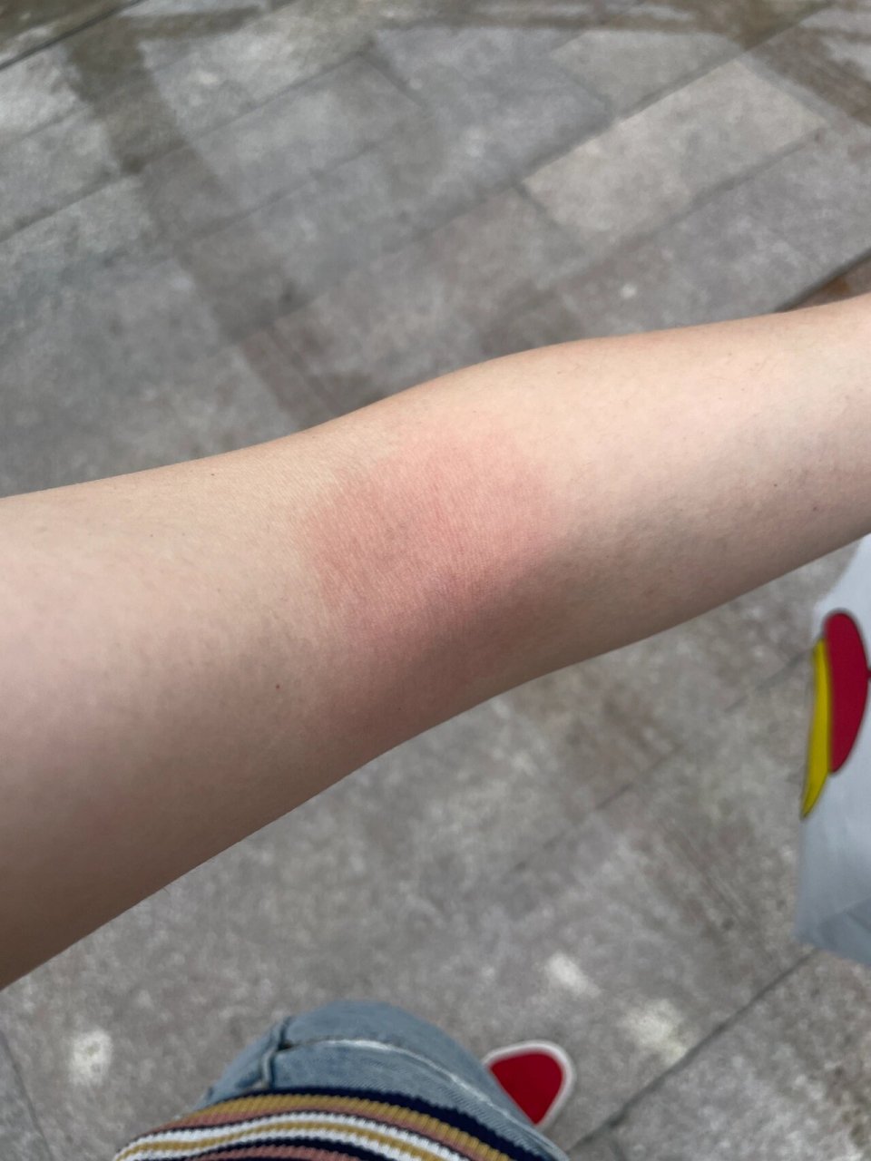 香水(酒精)过敏 有没有同体质的,香水一粘皮肤就过敏