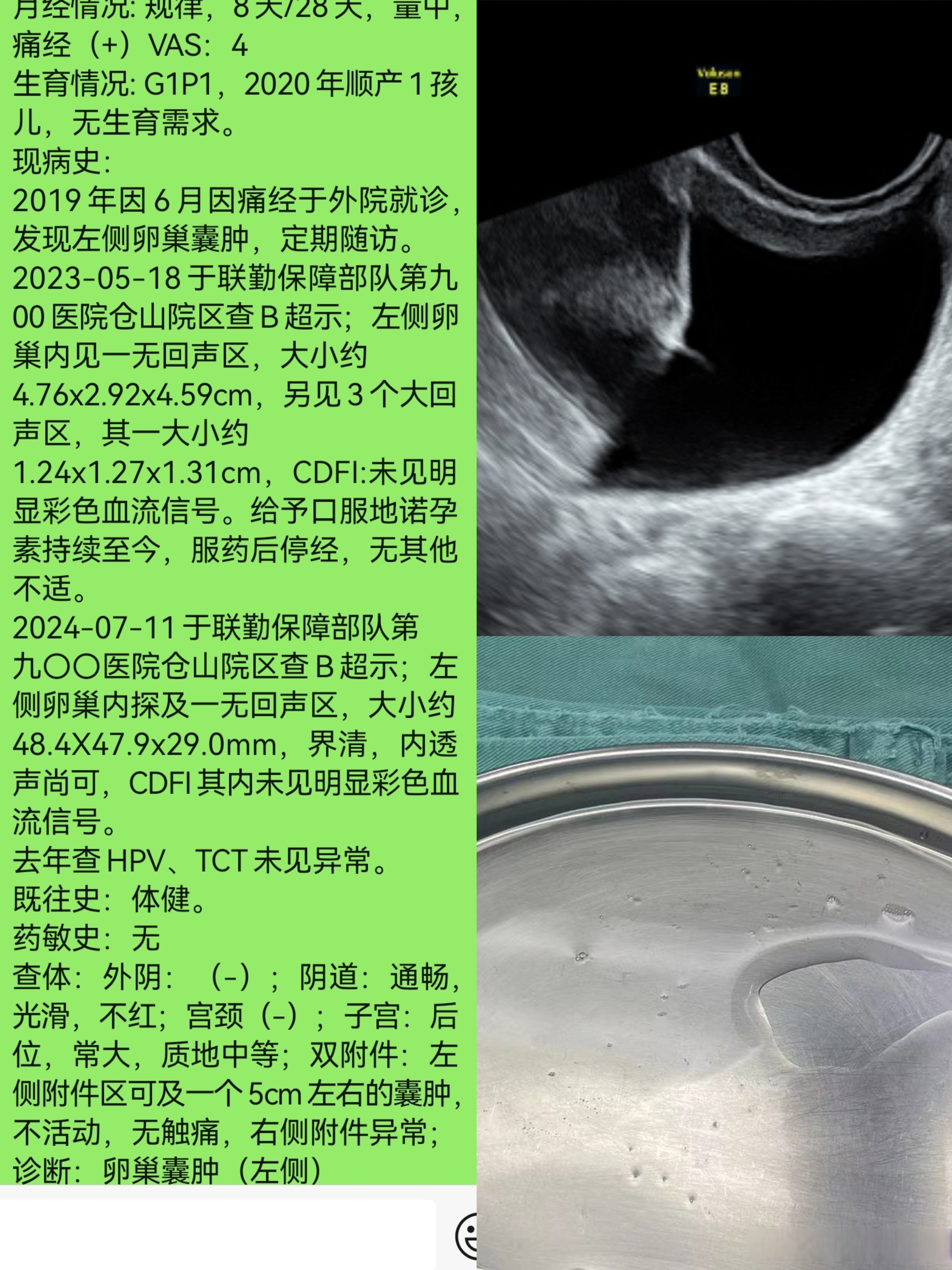 异位症高效的孕激素,吃了一年多,小的囊肿不见了(可能是生理性囊肿)