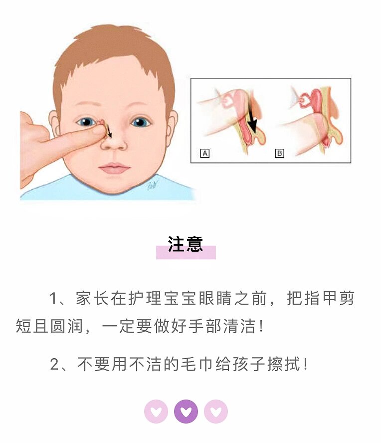 按摩图  98小米兜出生后几天就发现左眼一直没怎么睁开,好像被眼屎