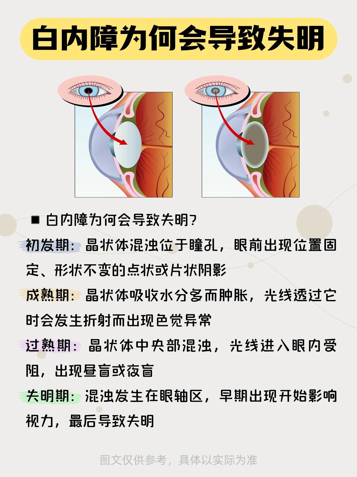 18张常见白内障图解图片