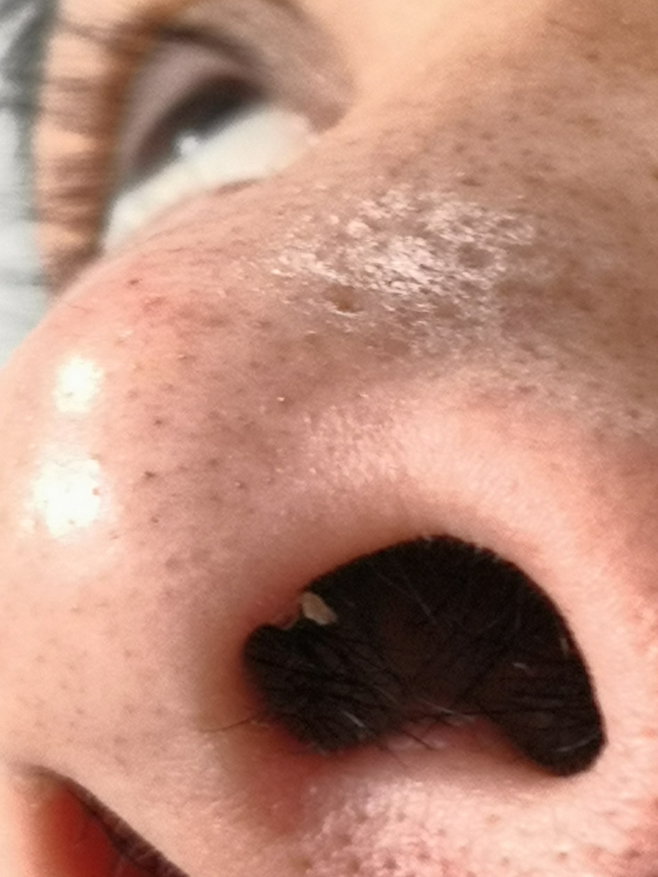 鼻孔内侧的寻常疣症状.和面部凹陷性疤痕.#美容##寻常疣