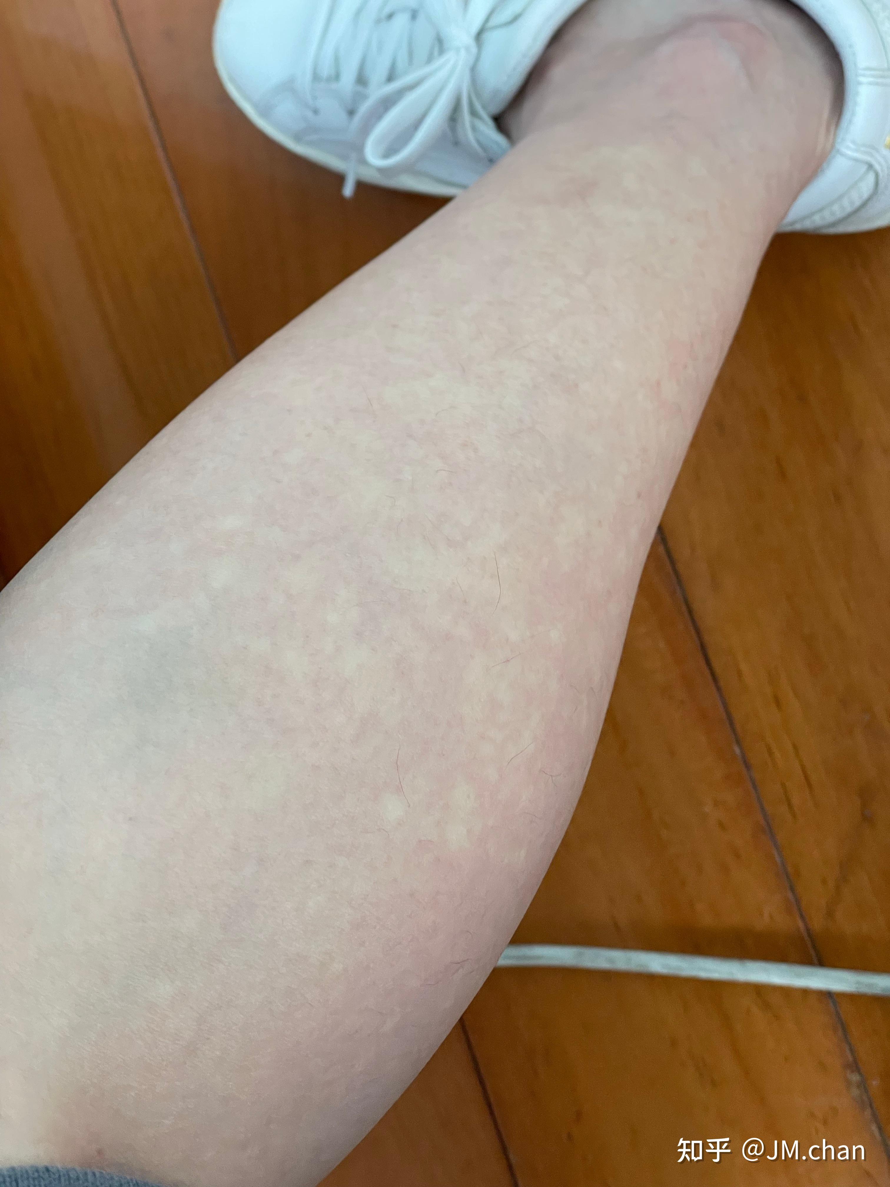 请医学界重视马歇尔怀特综合症贫血斑治疗