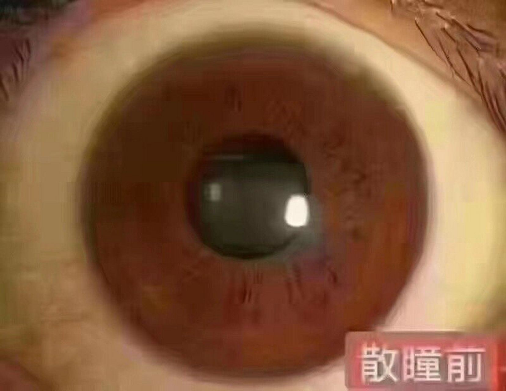 以下两张是孔瞳照片,可以看出,散瞳后瞳孔扩张到最大,遇光不收缩