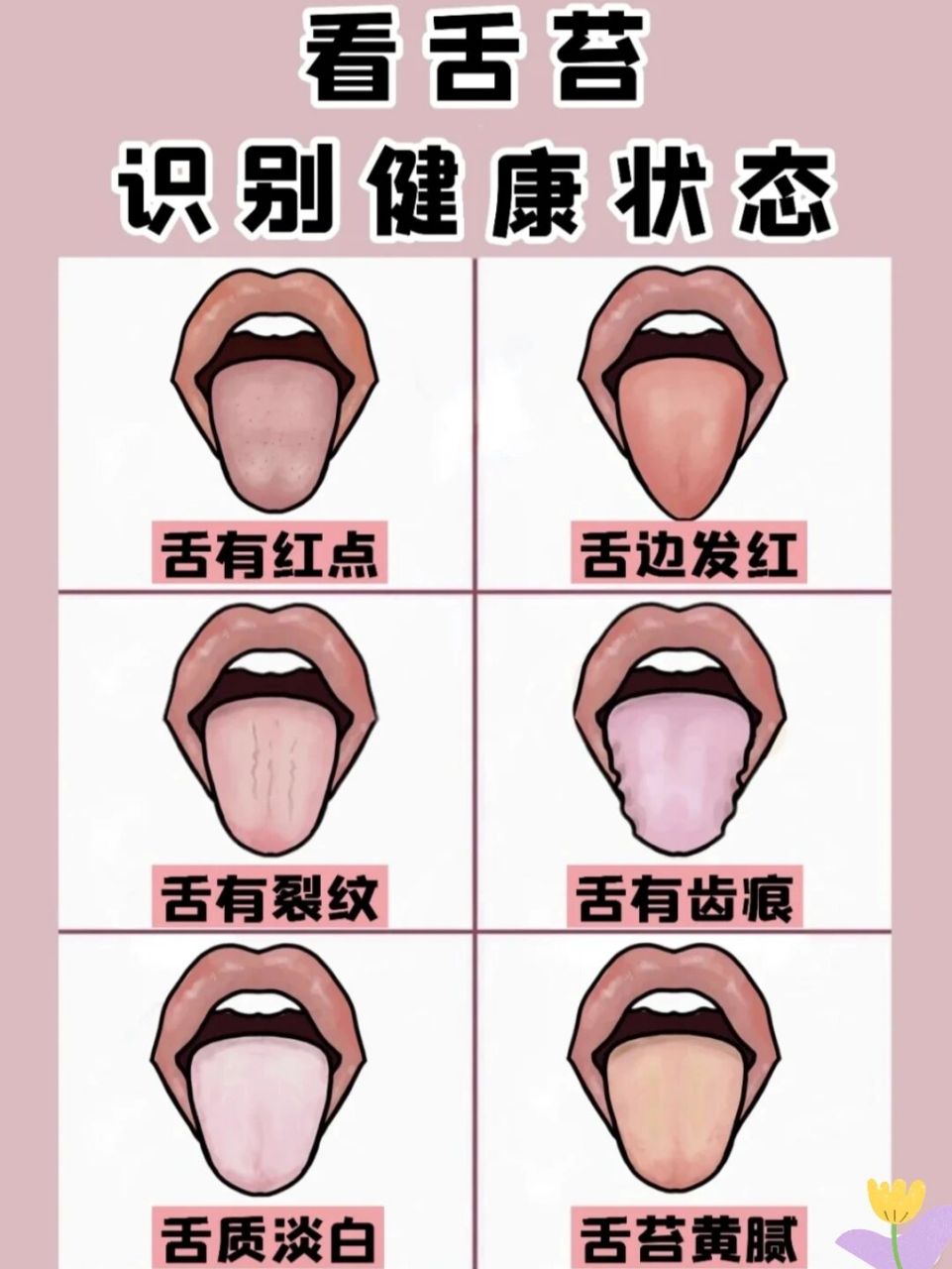 6种舌苔照片帮你识别健康情况,你中了哪个