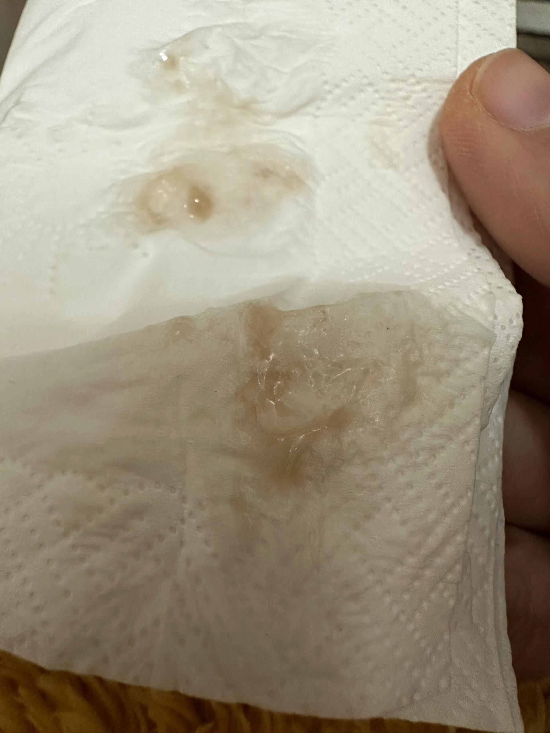 早早孕,最近出现偏褐色的分泌物,吓死我了