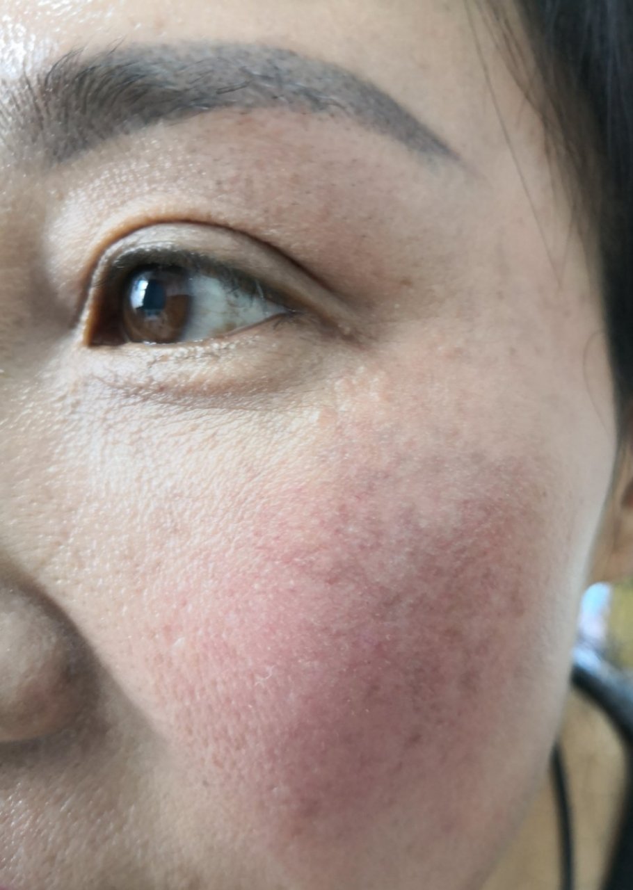 面部炎症反应有的会是黄褐斑的发病因素.#美容