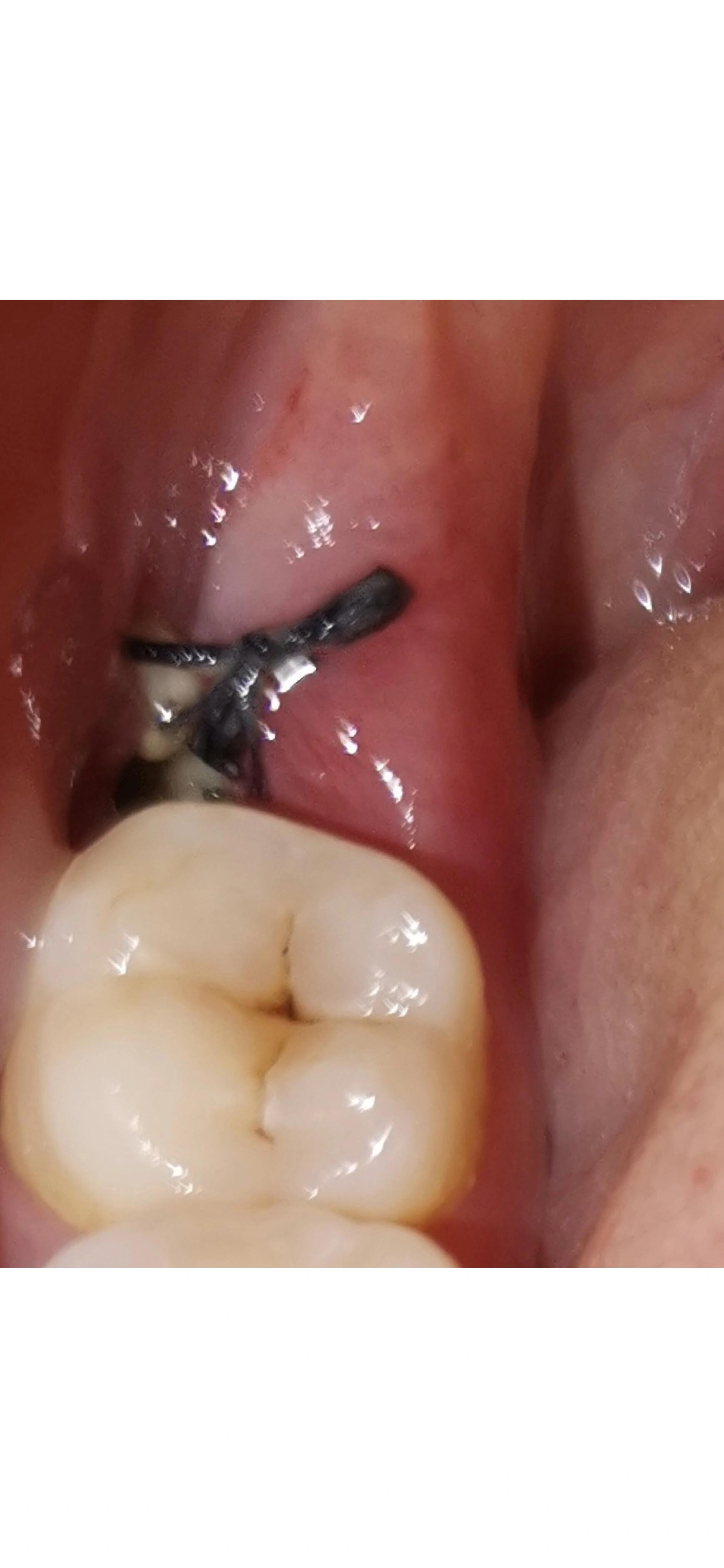 好害怕干槽症[期待],拔智齿第四天