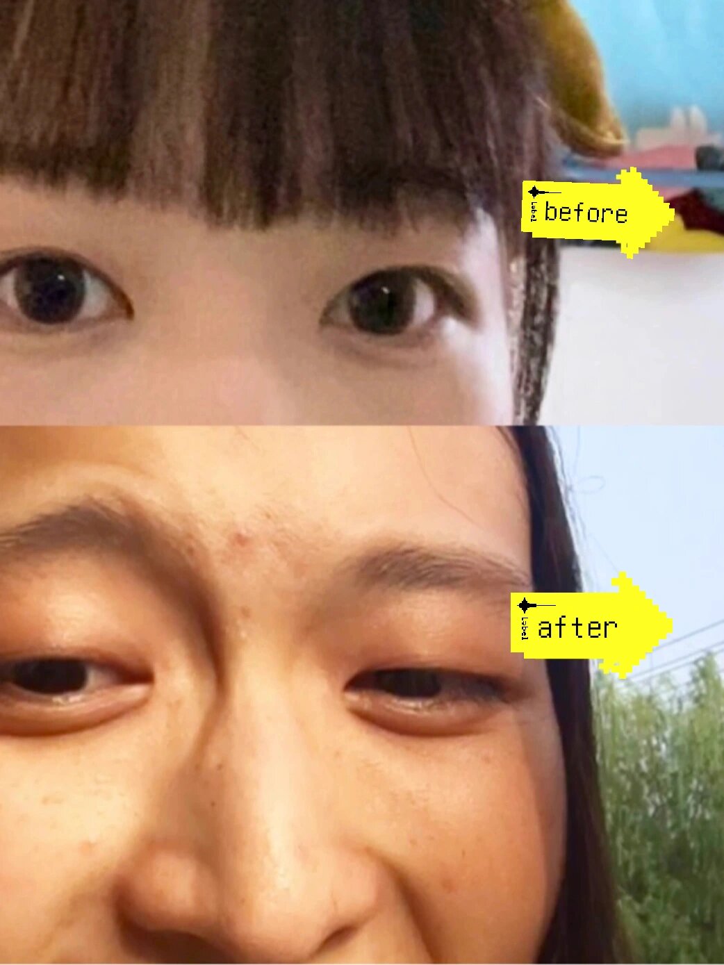 戴眼镜导致的眼睛变形怎么办,最全篇