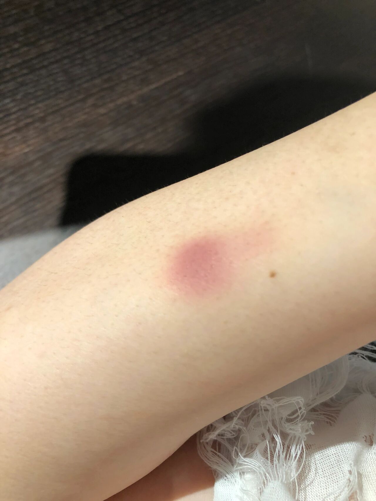 手臂上突然有红了一块儿,不痛不痒