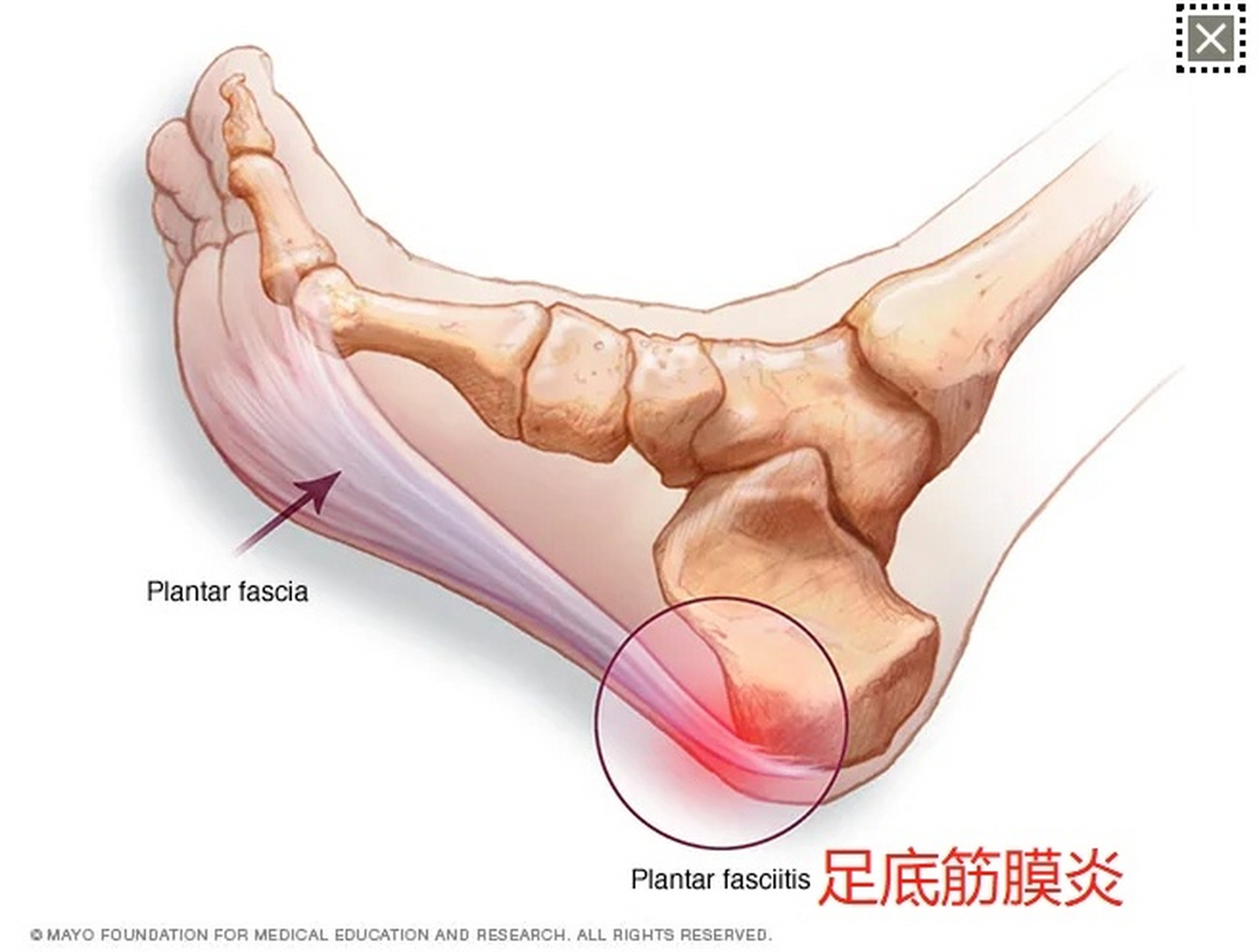 足底筋膜炎是指足底连接跟骨和脚趾的纤维组织(足底筋膜)的炎症.