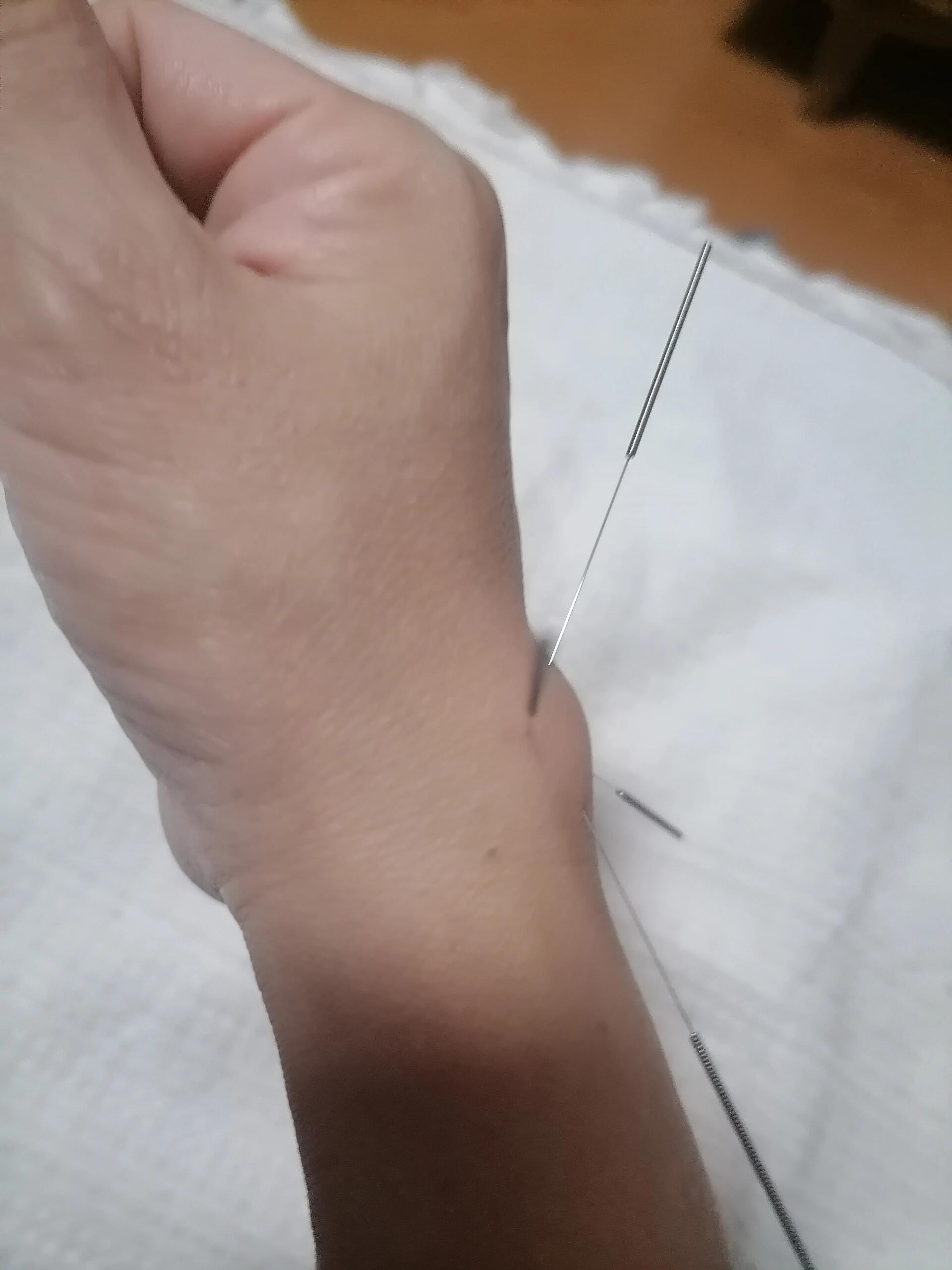 零消费,不做手术,自己治愈腱鞘囊肿