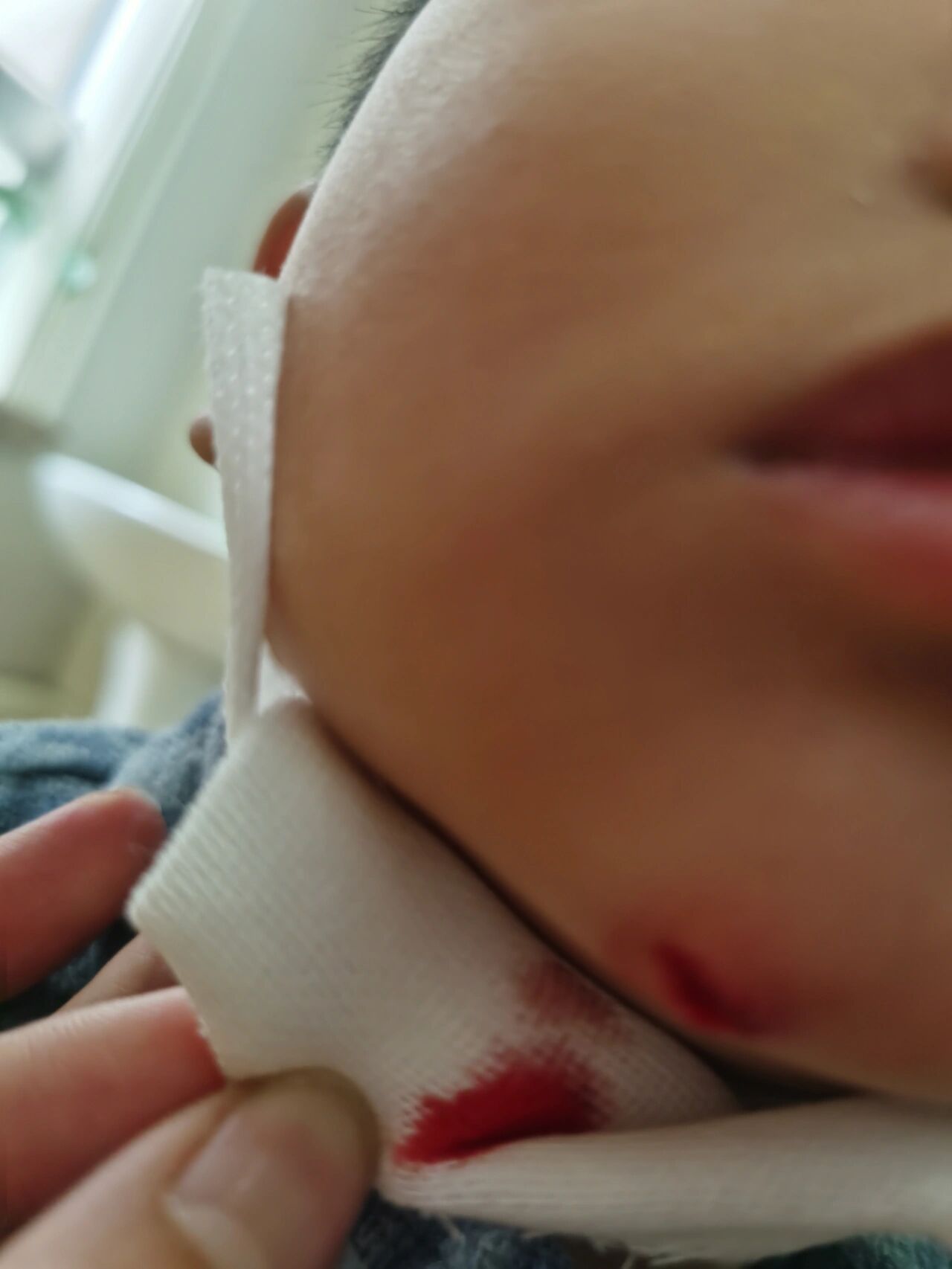 老二又磕着下巴.缝针好还是自己愈合好呢