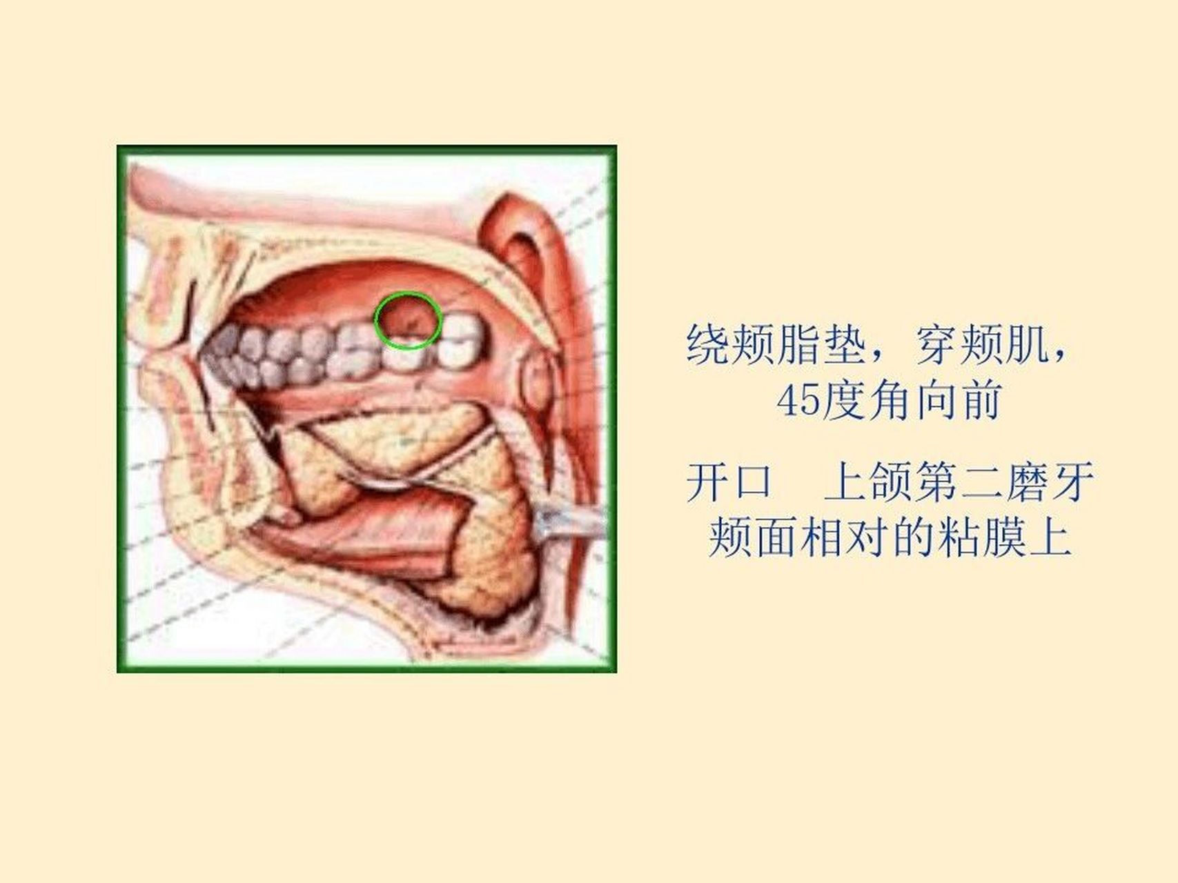 腮腺管堵塞图片