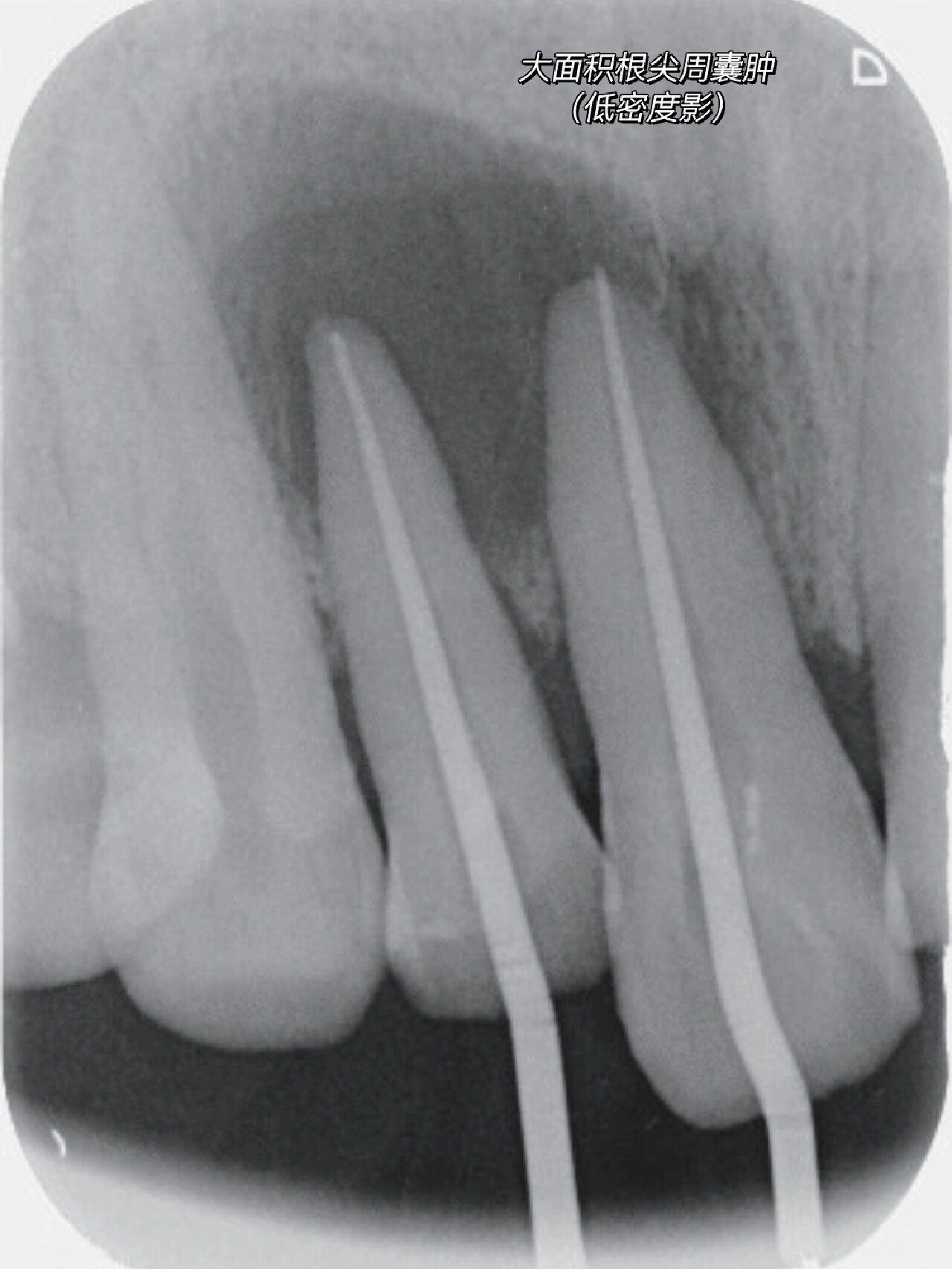 慢性根尖周炎牙片图片