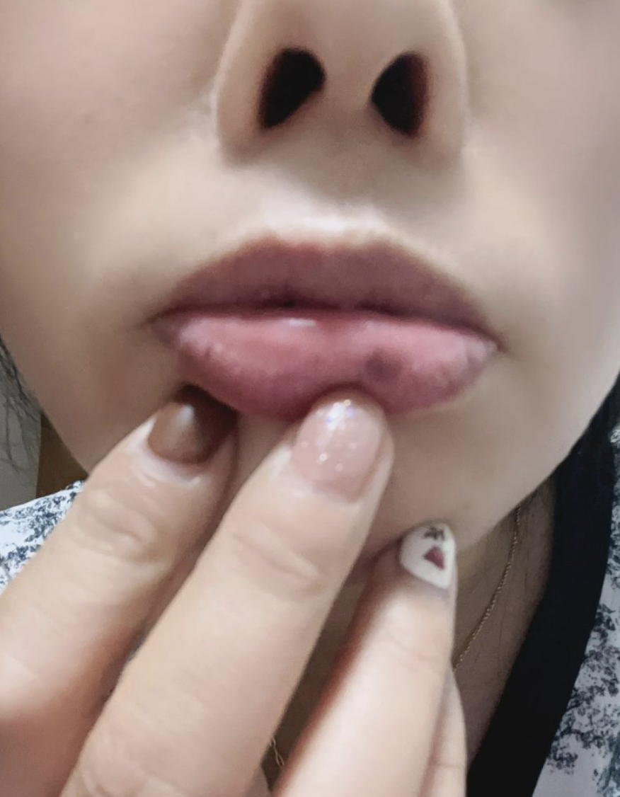 嘴唇上长黑斑可能和外部刺激,色素沉淀或其他疾病有关