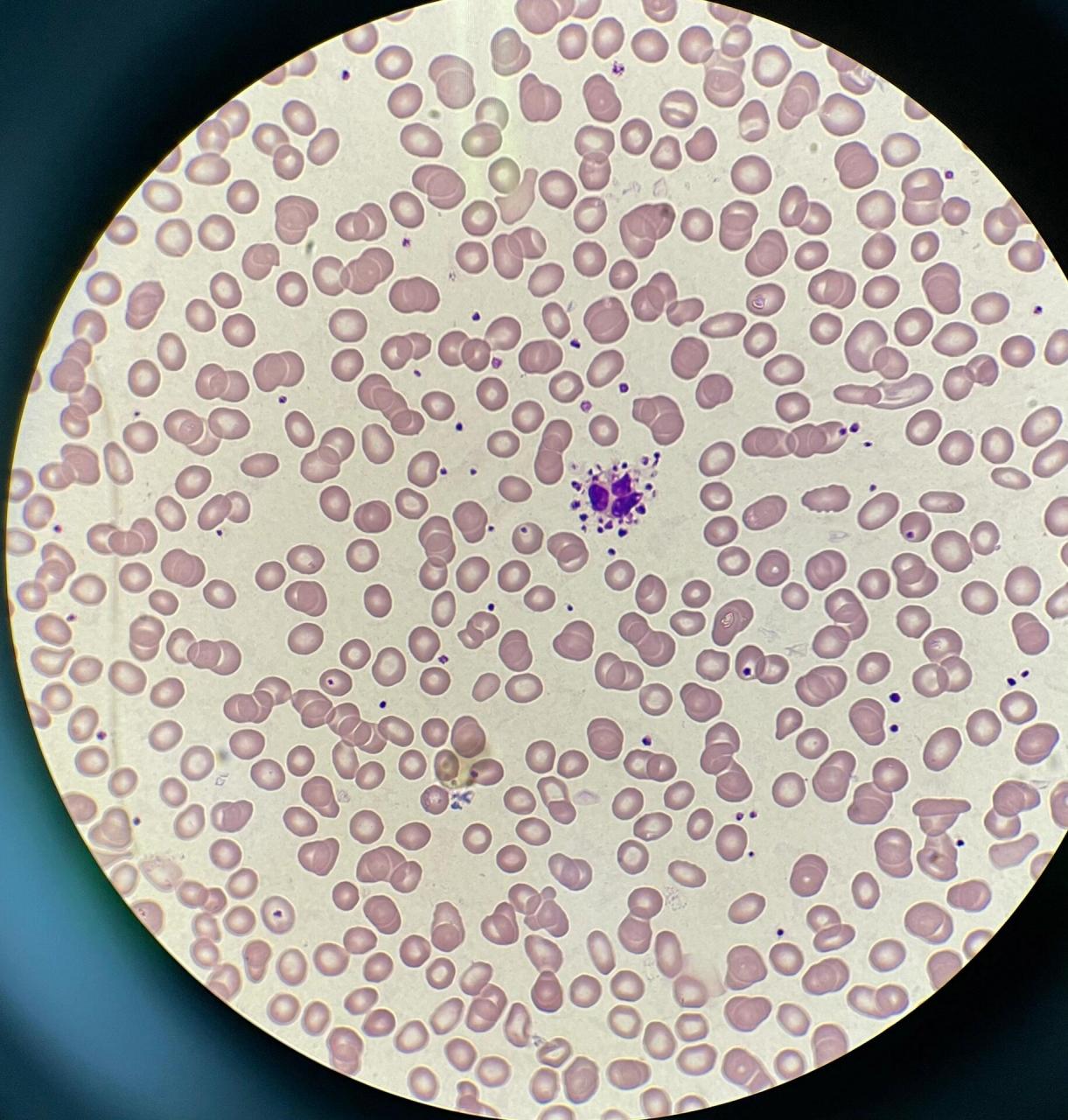 0615血小板卫星现象 99血小板卫星现象是血小板粘附,围绕于中性