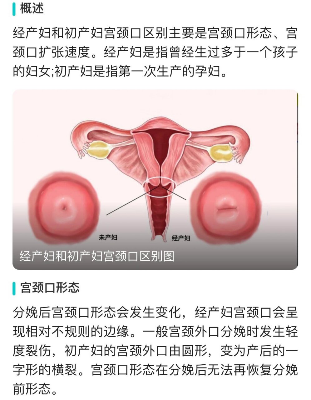 经产妇宫颈口图片