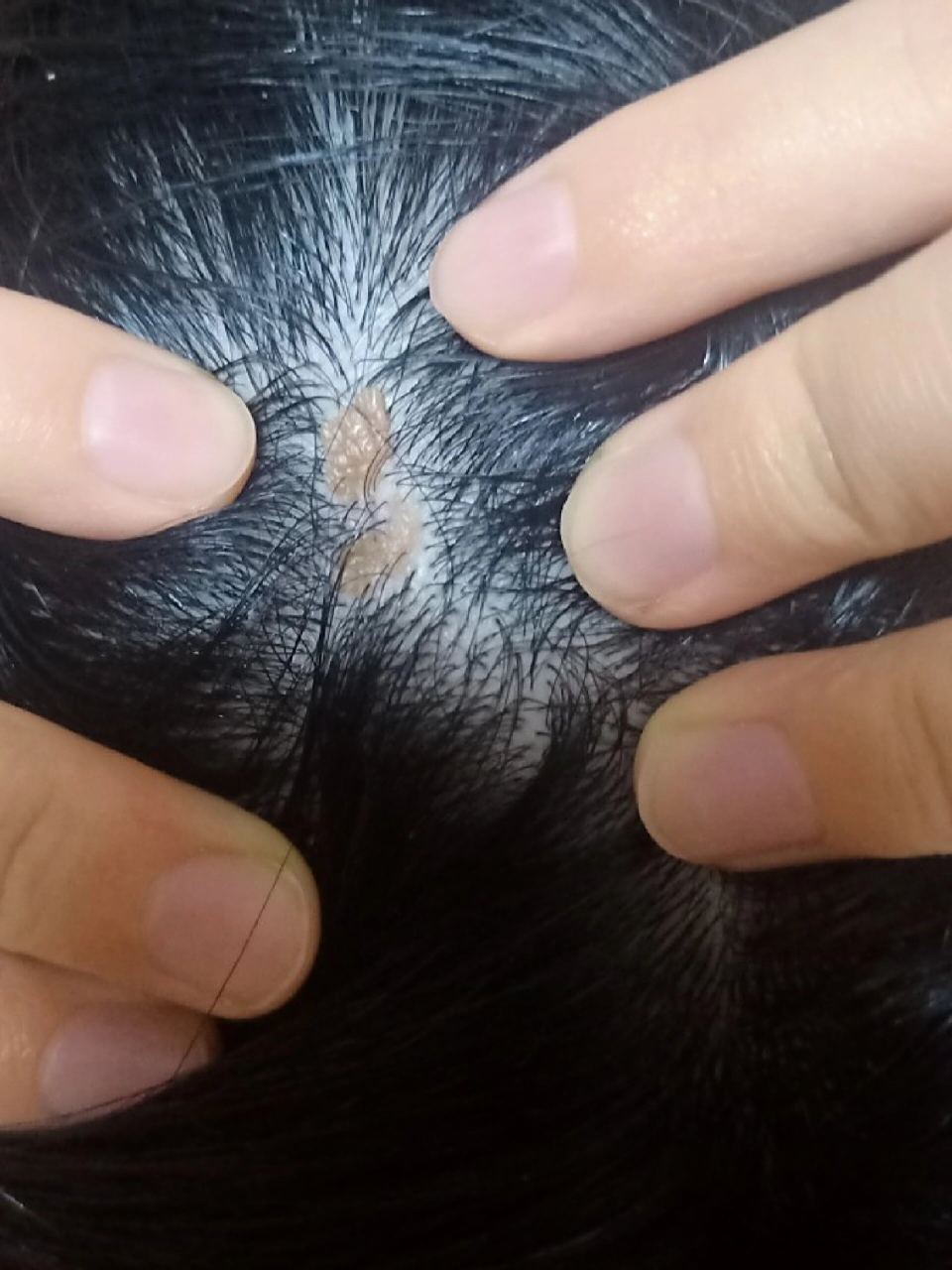 头皮长疣,看过医生说是疣让激光 这个是会自体传播吗?