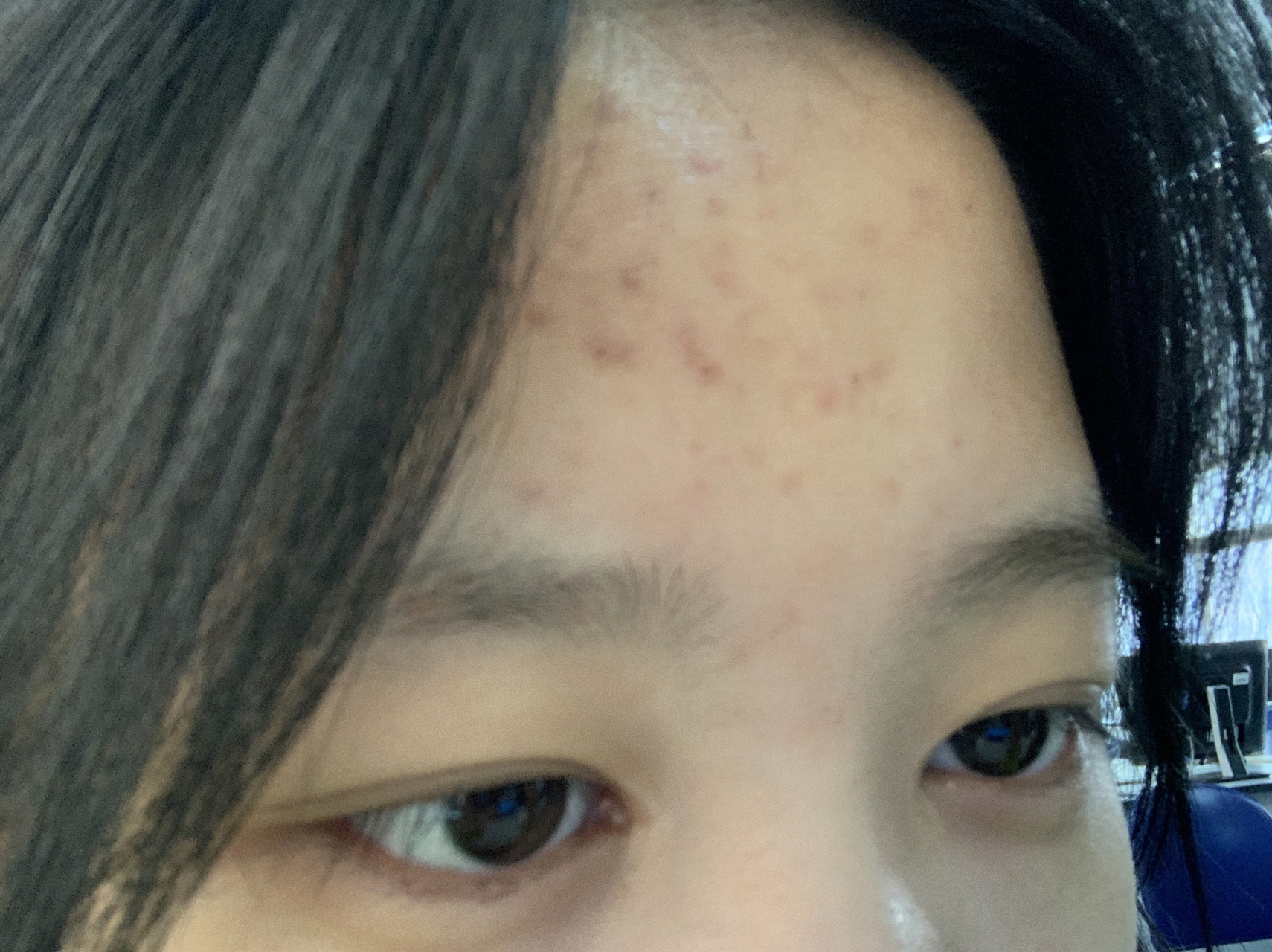 第二次针清后第6天 今天起来以后额头上红色痘印都浅了很多,左侧脸颊