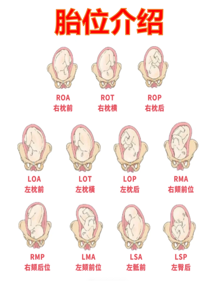 胎位左枕前是指胎儿头部的枕骨位于妈妈骨盆的左前方位置
