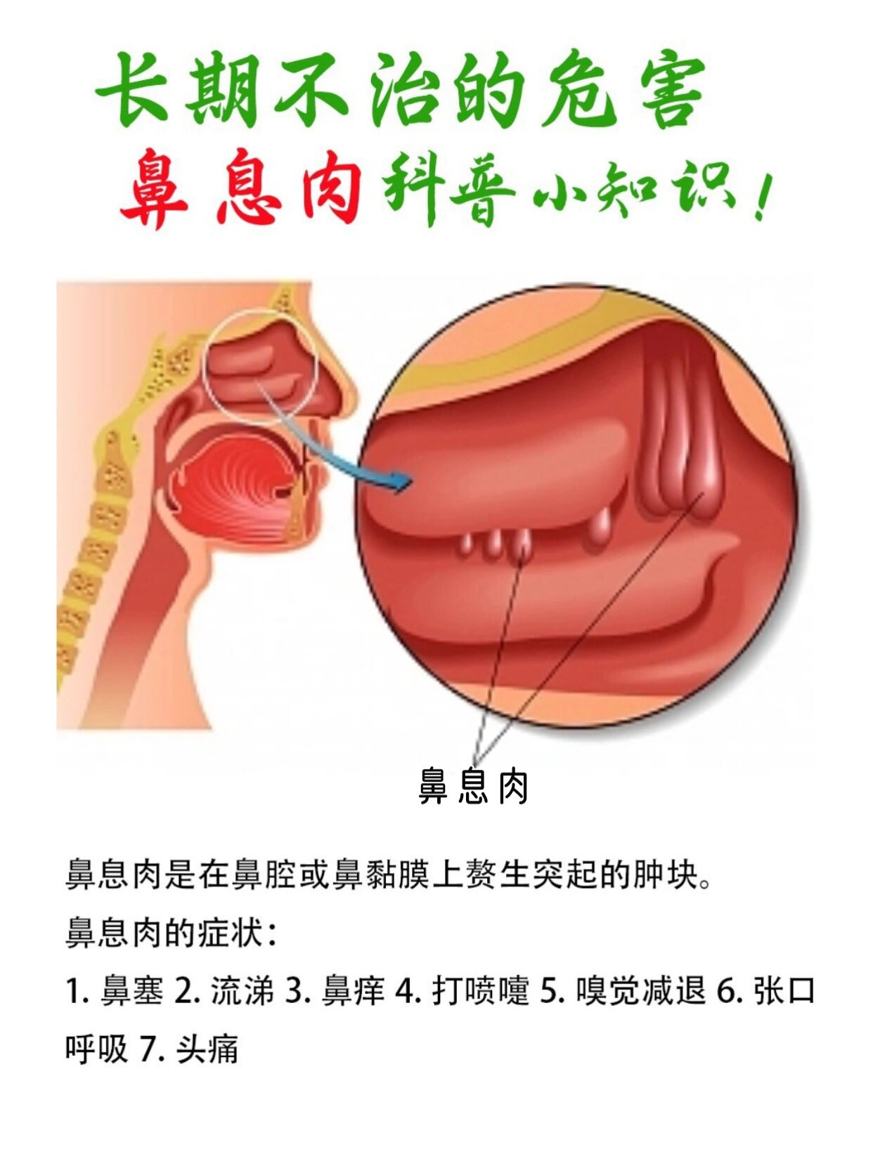 鼻息肉长期不治的危害