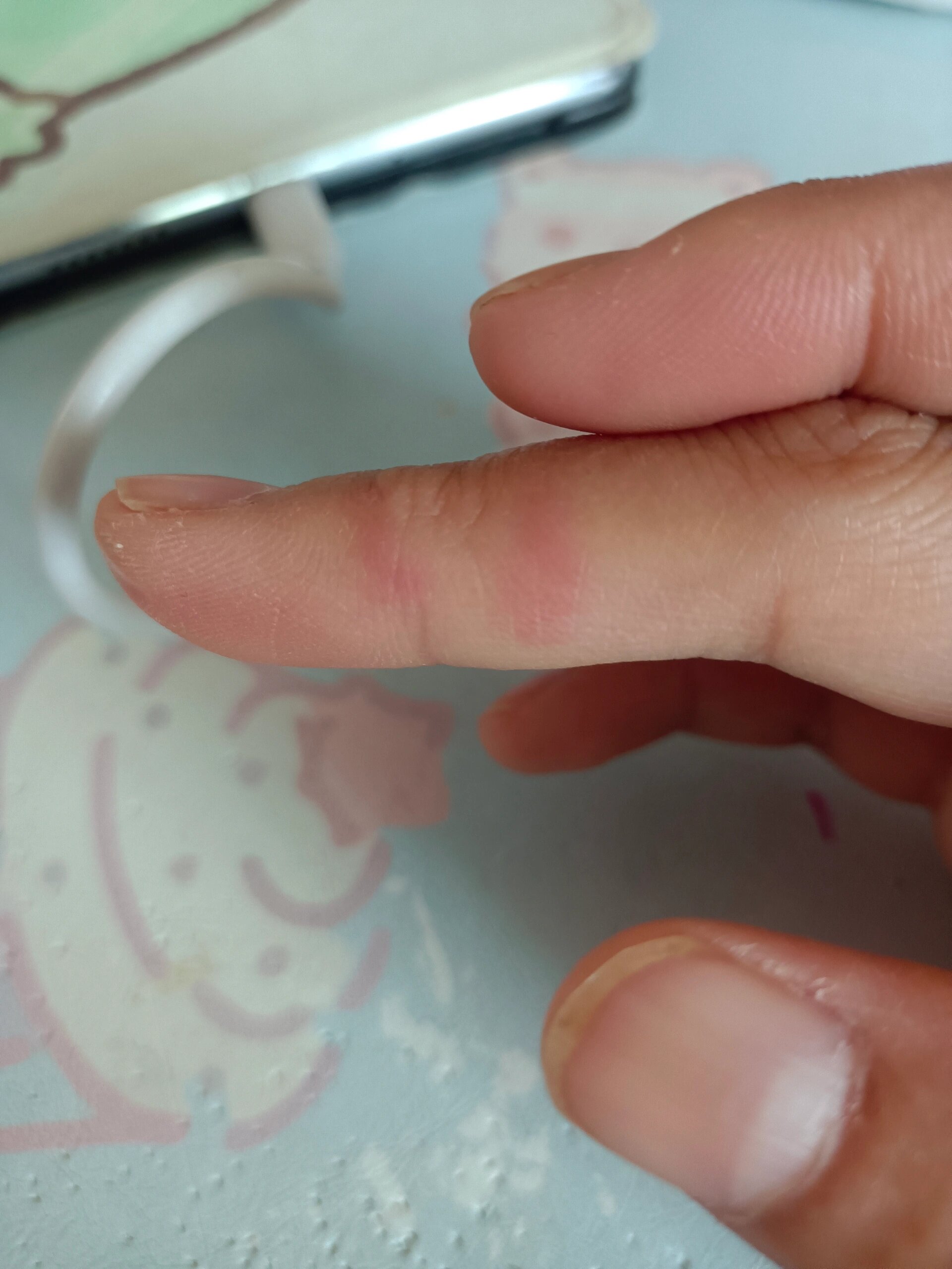 手指侧面反复长红包,痒疼痒疼!