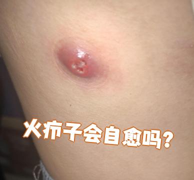 但症状严重的可能需要用药或手术