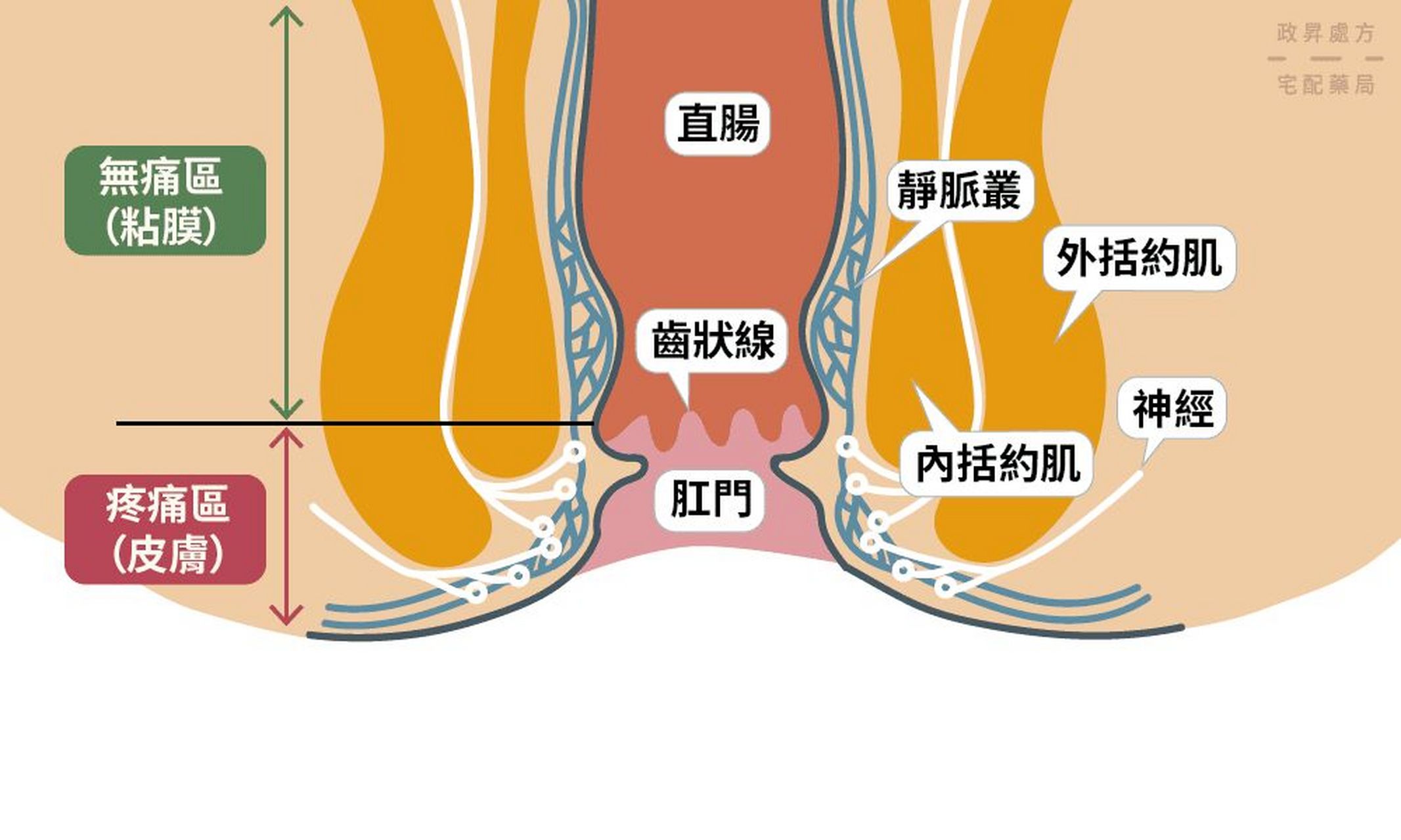 外痔疮图解图片