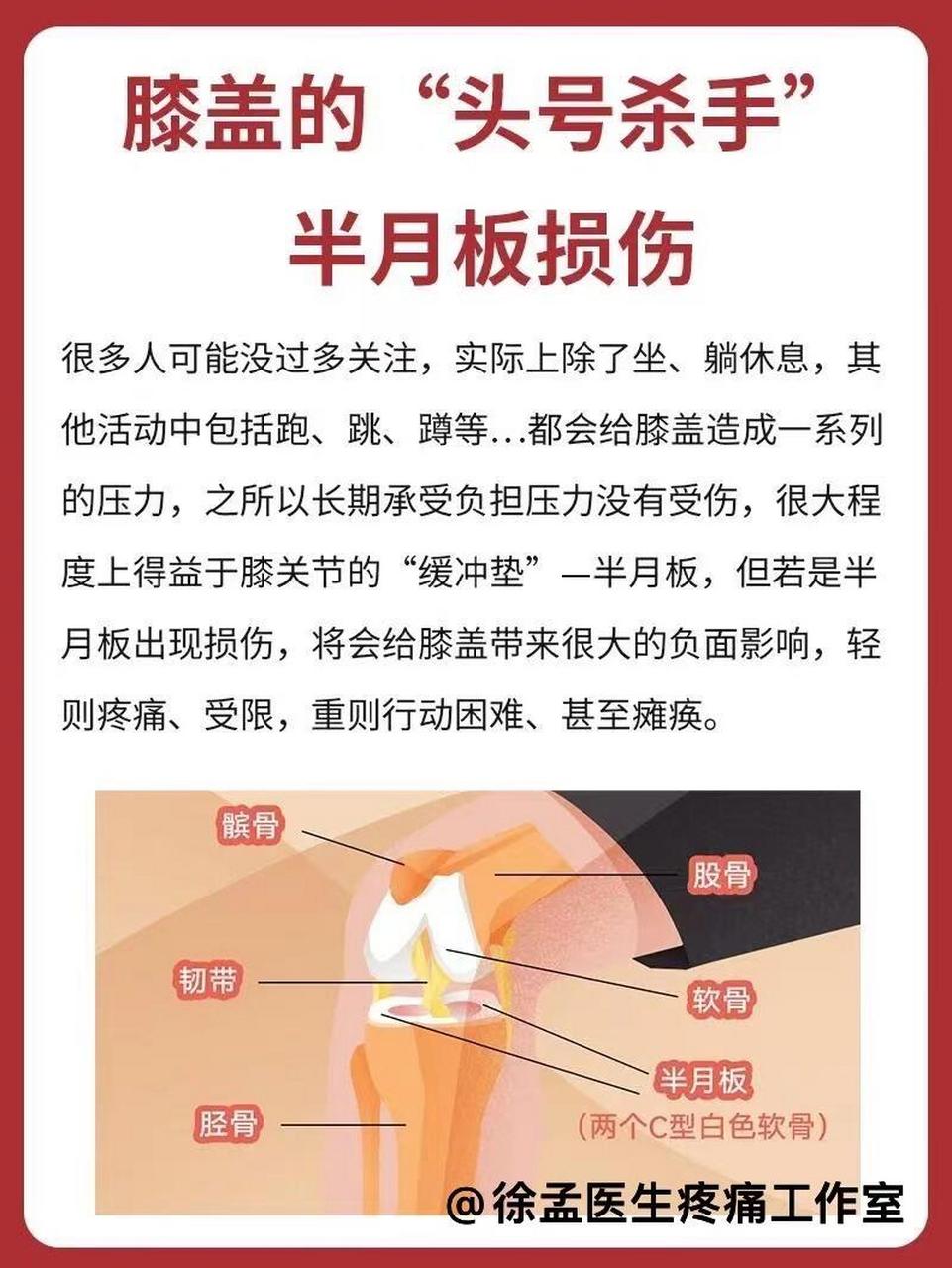 半月板损伤的原因图片