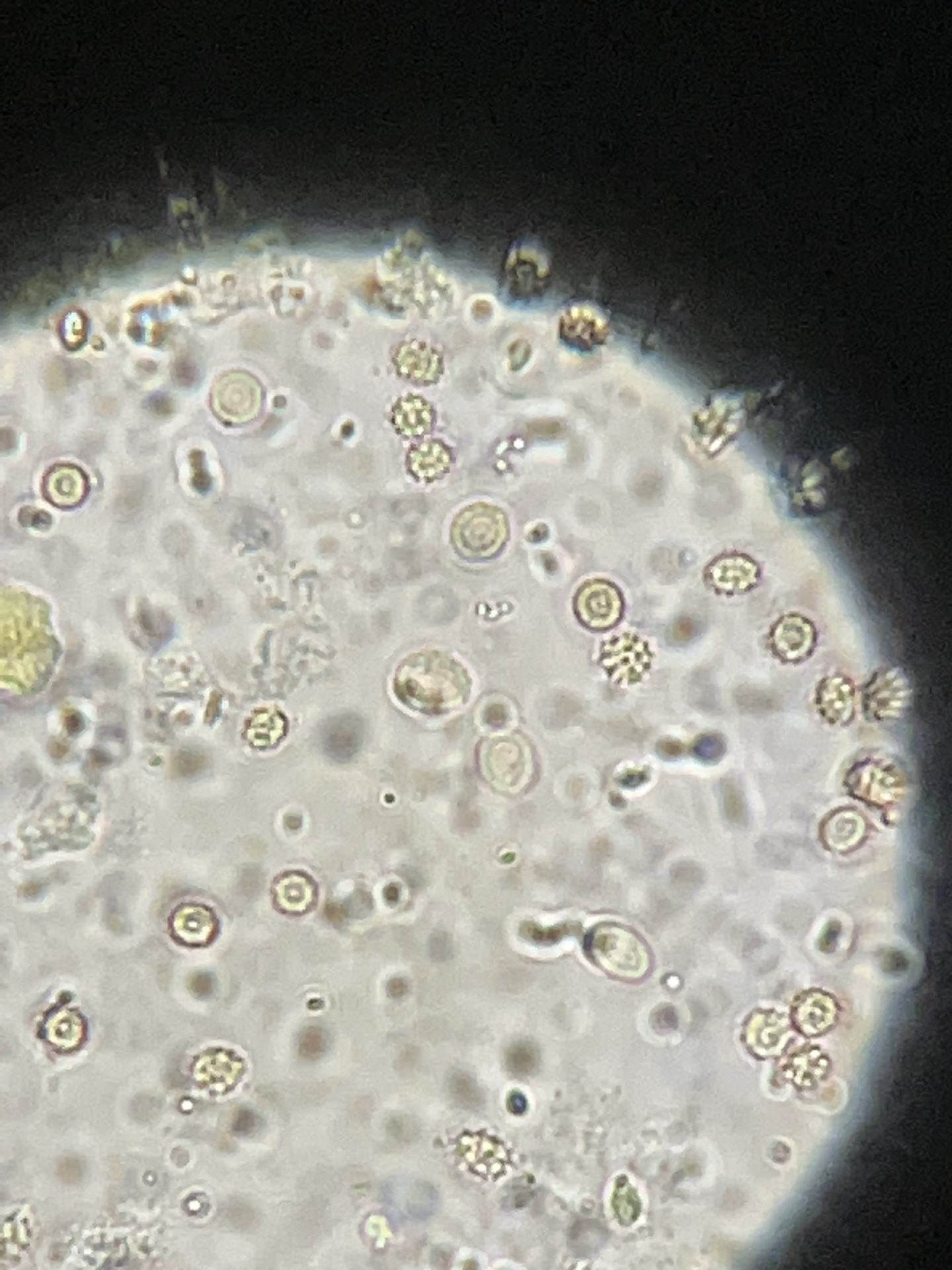 记录95 粪便常规 性状:血样便 隐血:阳性 镜检:红细胞3 (谨慎修改一