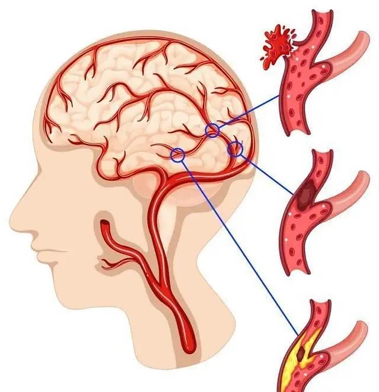 脑的小血管病变预示着什么?