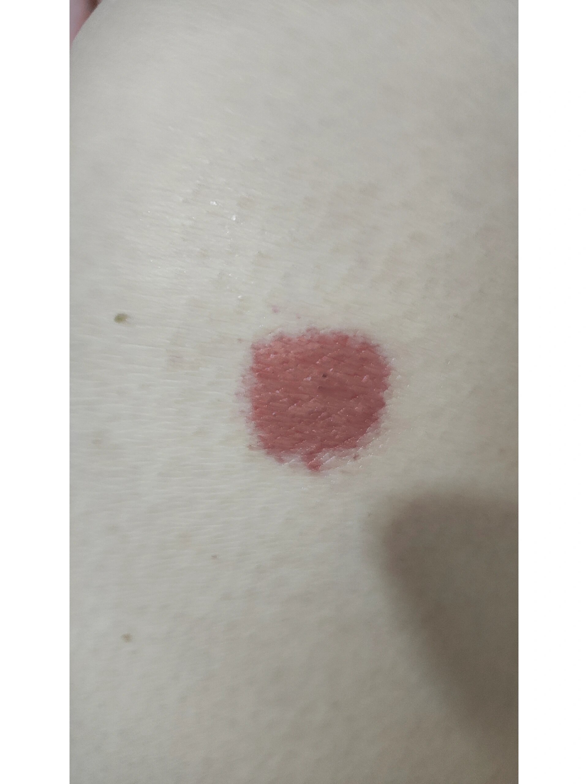 腿上长了个红色的块不知道是什么