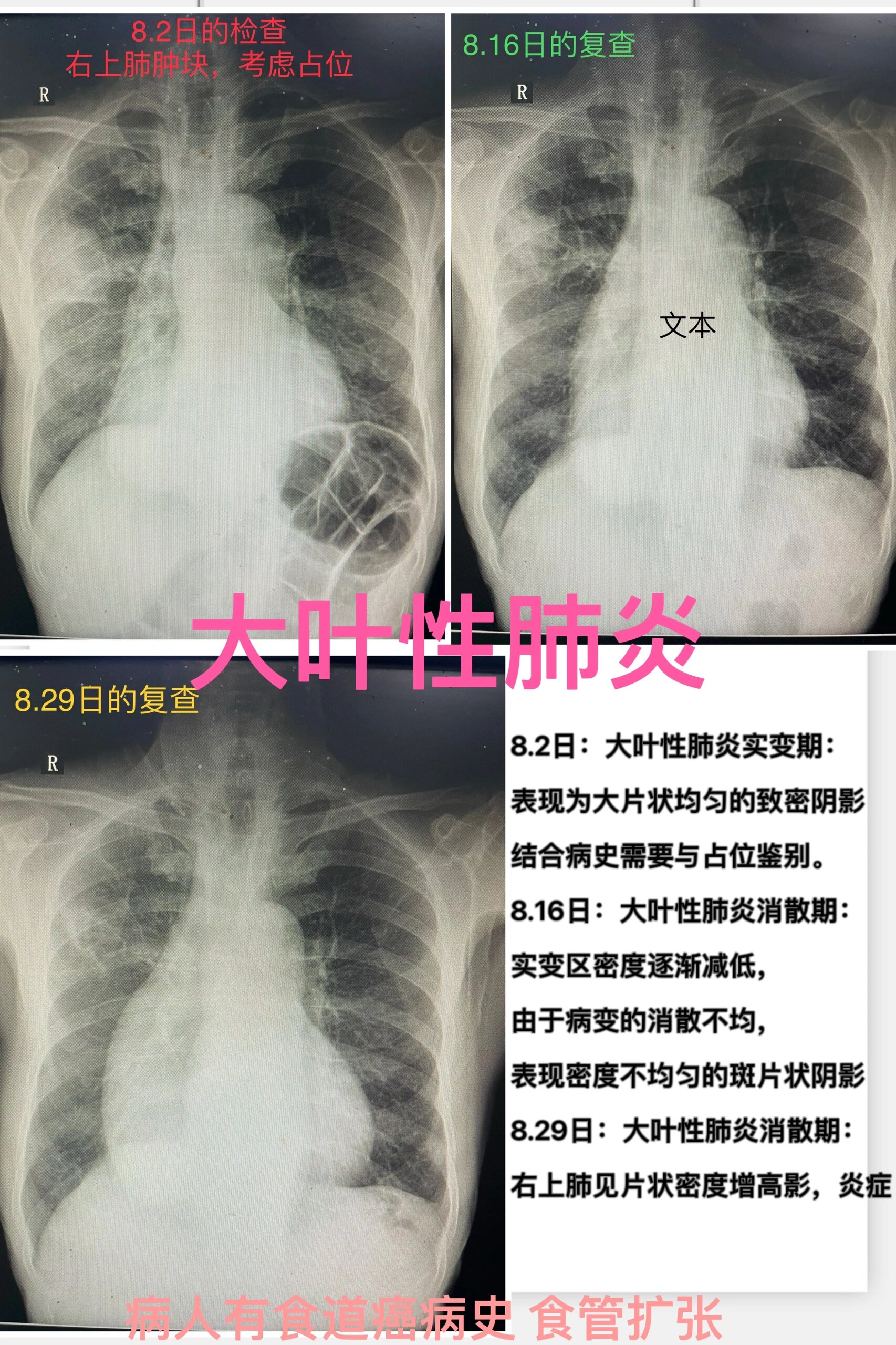 大叶性肺炎的影像学表现(x线 ct) 大叶性肺炎7815781578