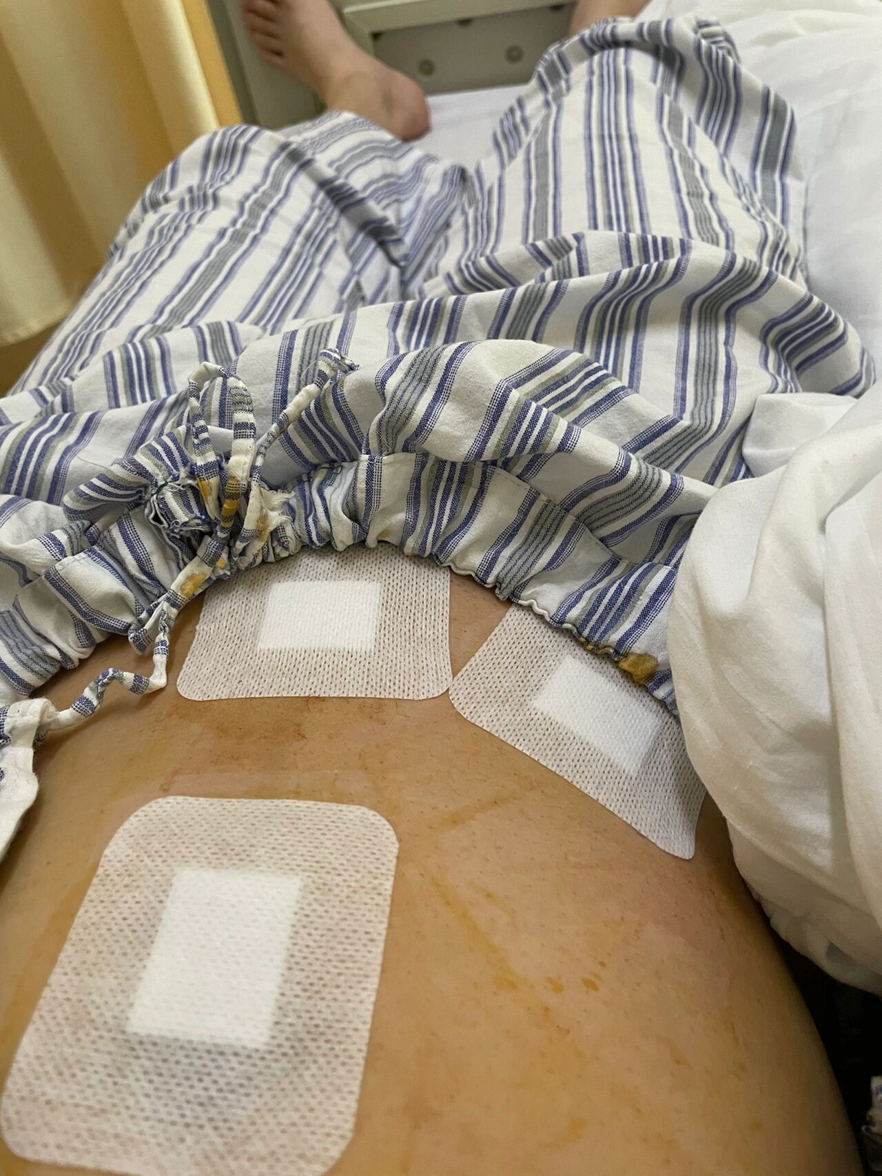 刚做了阑尾炎微创手术 	 医生给我上了两个不可吸收塑料夹子 大家做