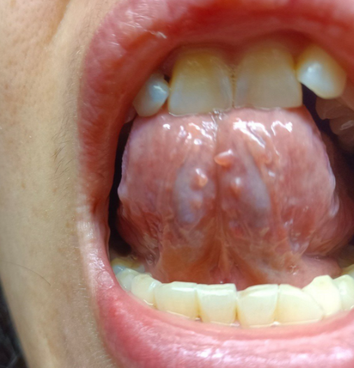 舌头底下长个菜花状的东西,可能是口腔尖锐湿疣,口腔溃疡或舌部肿瘤