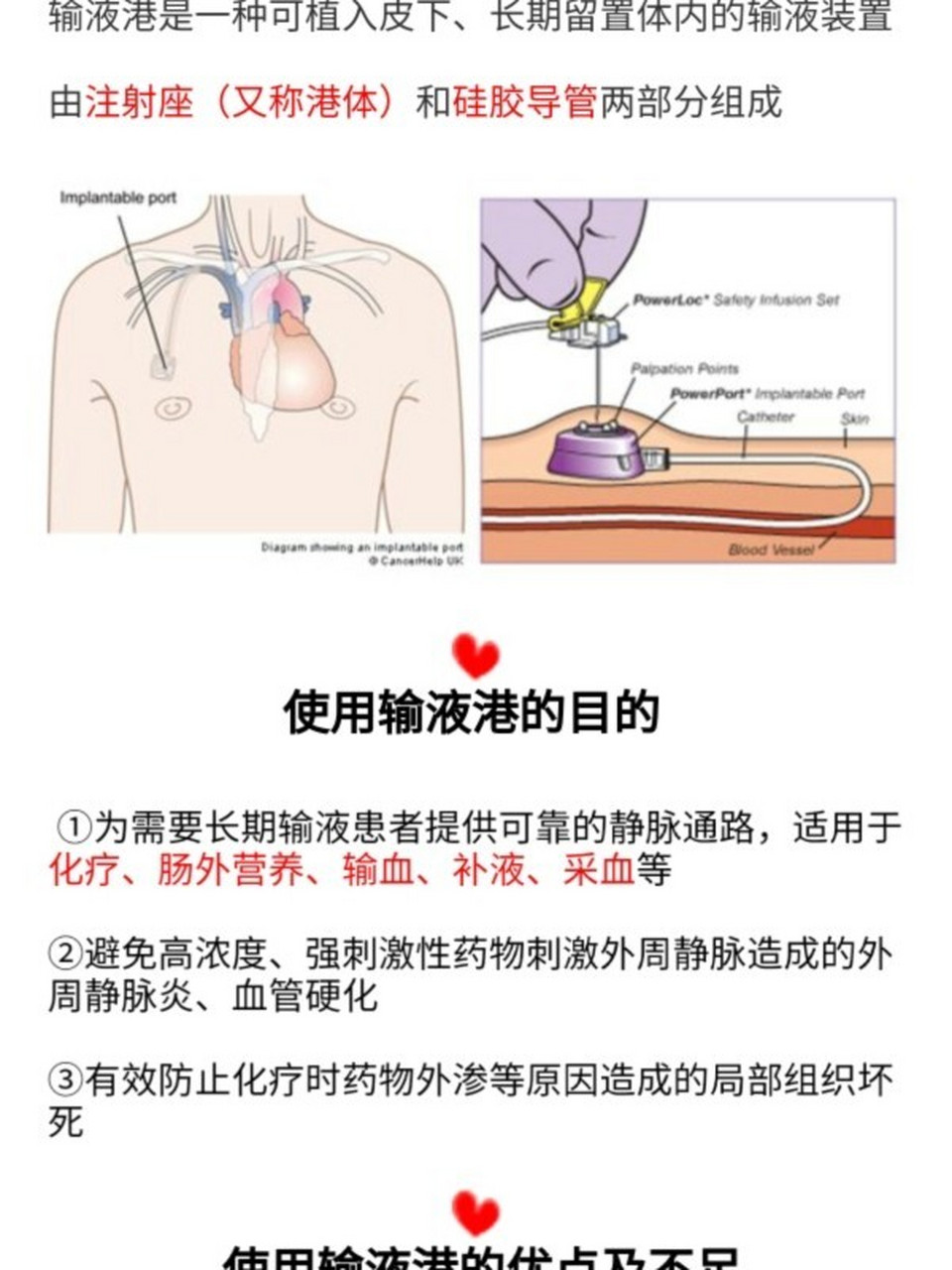 输液港置管位置图解图片