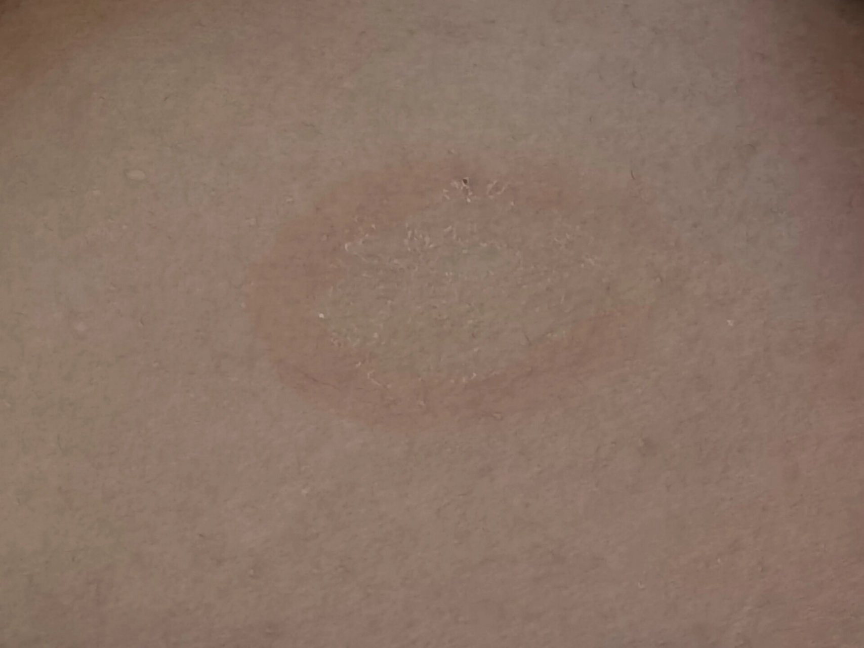 身上突然有了这样一个圆圈  不疼不痒  蜕皮是怎么回事啊 一开始是