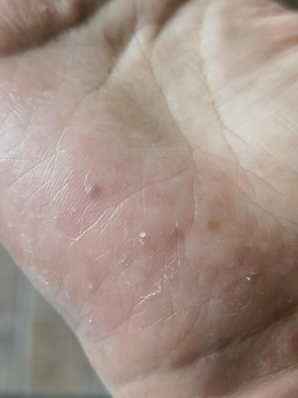 女36岁, 从小手脚汗多,每年都长汗疱疹,这次汗疱症第一次好了以后,不