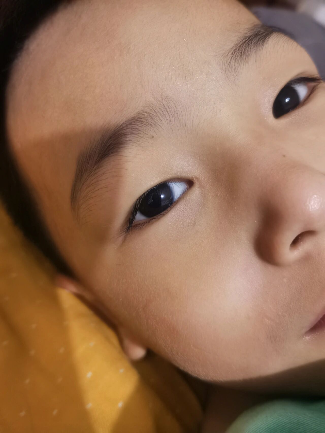 泪囊瘘术后4个月