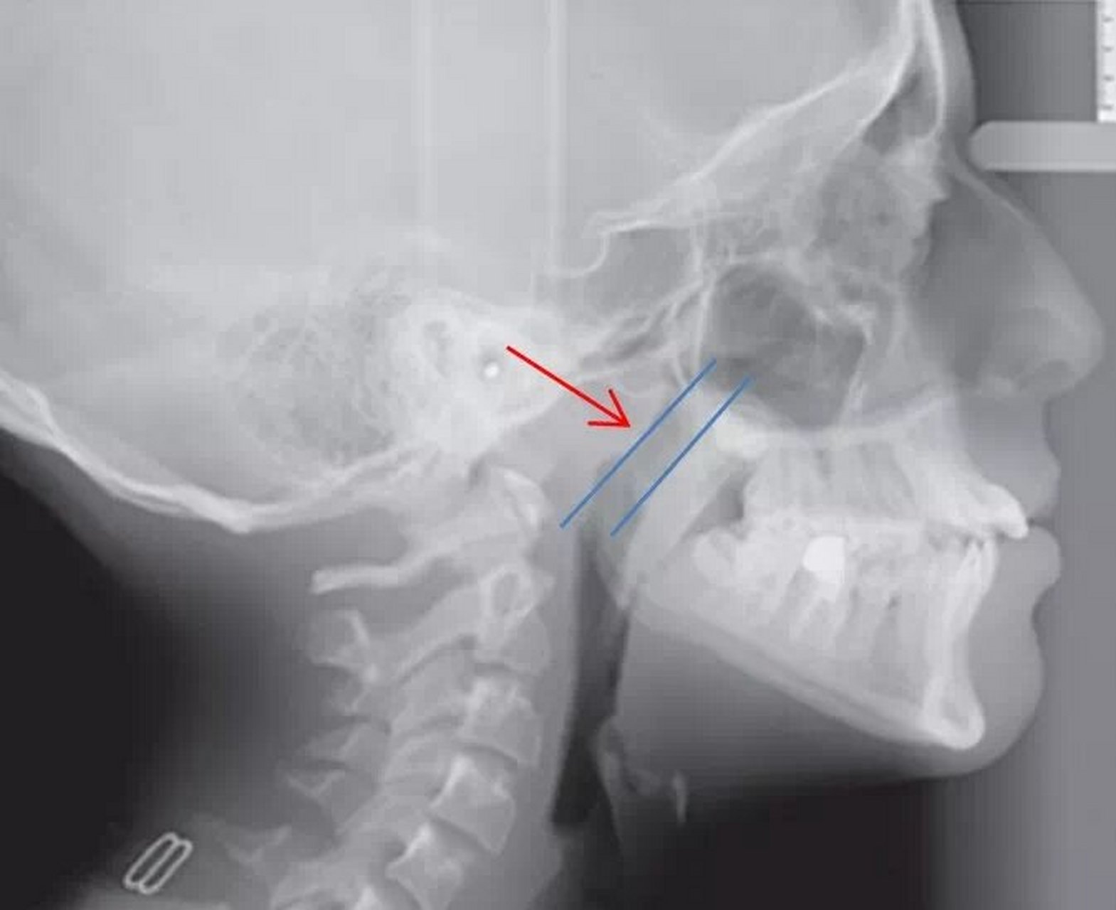 腺样体肥大的测量:首选鼻咽侧位x线片.