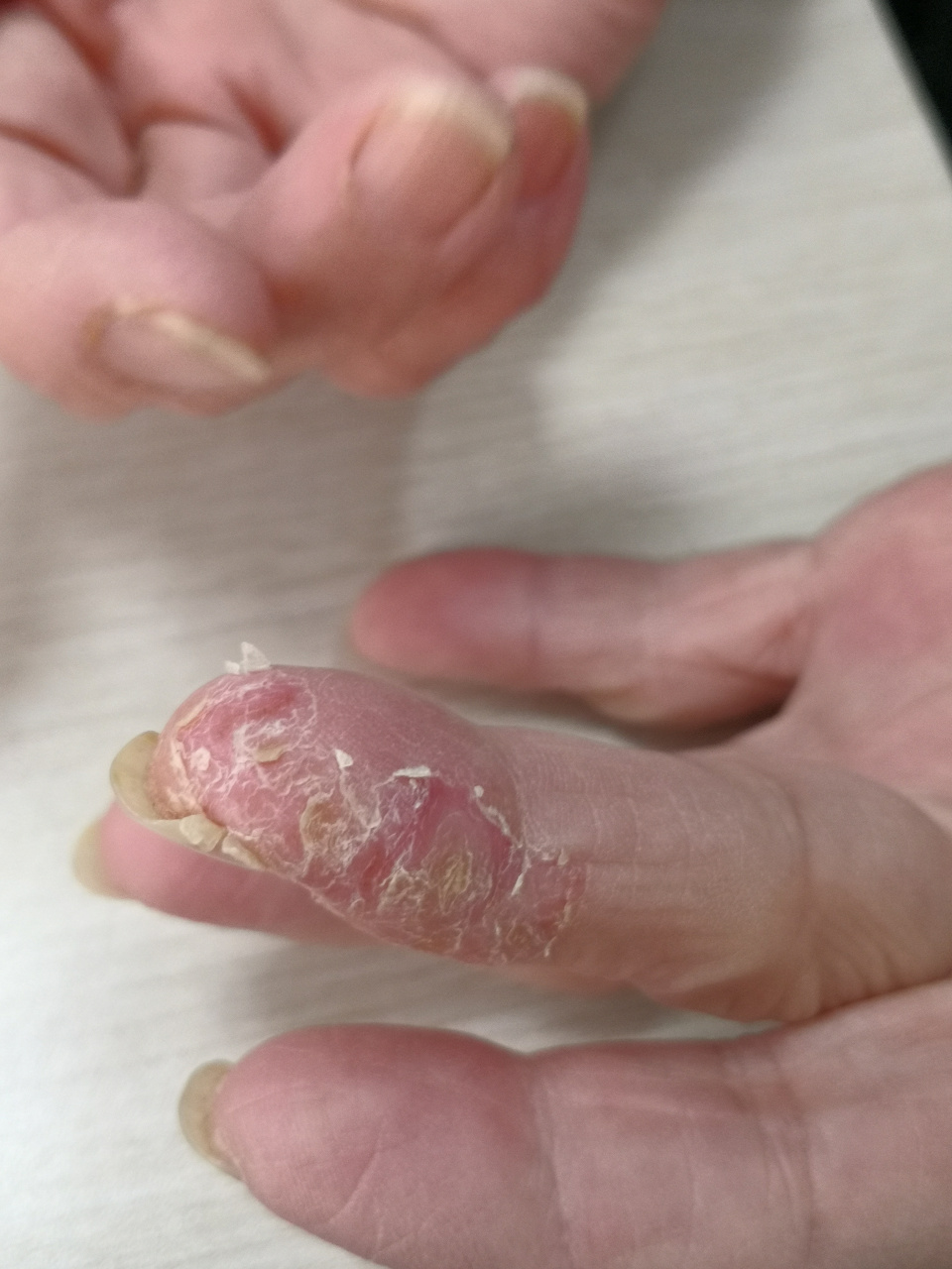 手指湿疹症状#接触性皮炎