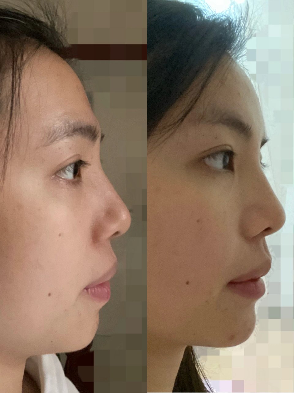 侧脸变好看～原来额头后倾对颜值影响这么大 想和大家分享一下6.