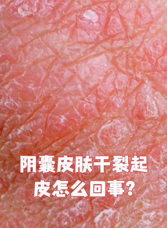 阴囊皮肤干裂起皮常见原因有三种:阴囊湿疹,阴囊炎和阴囊过敏