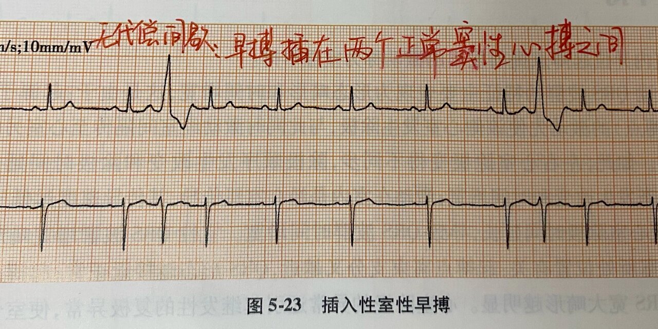 室性早搏心电图特点图片