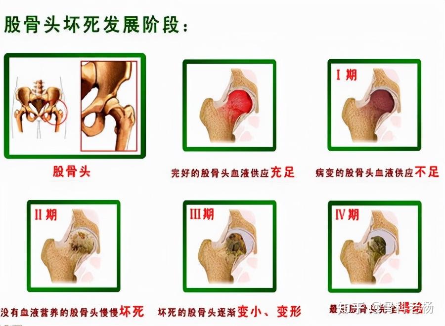 明确股骨头坏死分期对症治疗事半功倍