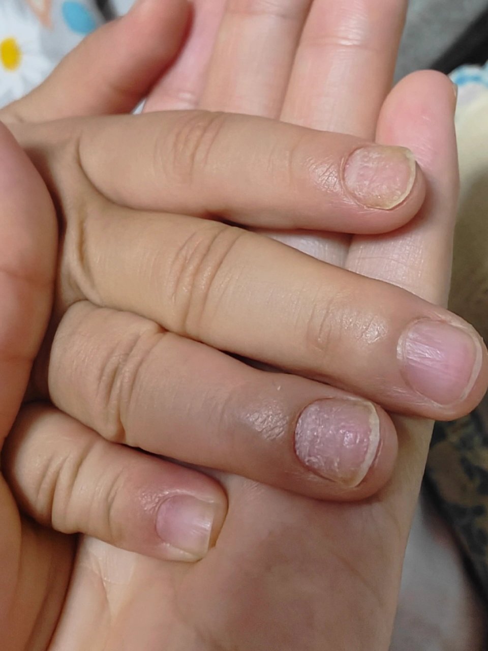 6岁小朋友指甲为什么这样 大概几个月前发现女儿有一两个指甲有凹凸