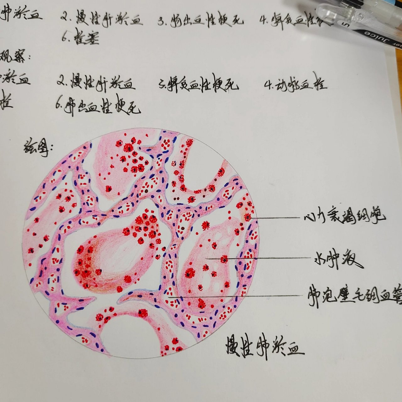 慢性肺淤血 慢性肺淤血病理切片红蓝铅笔绘图