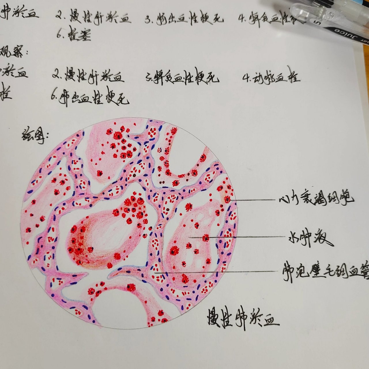 肺淤血病理作业图图片