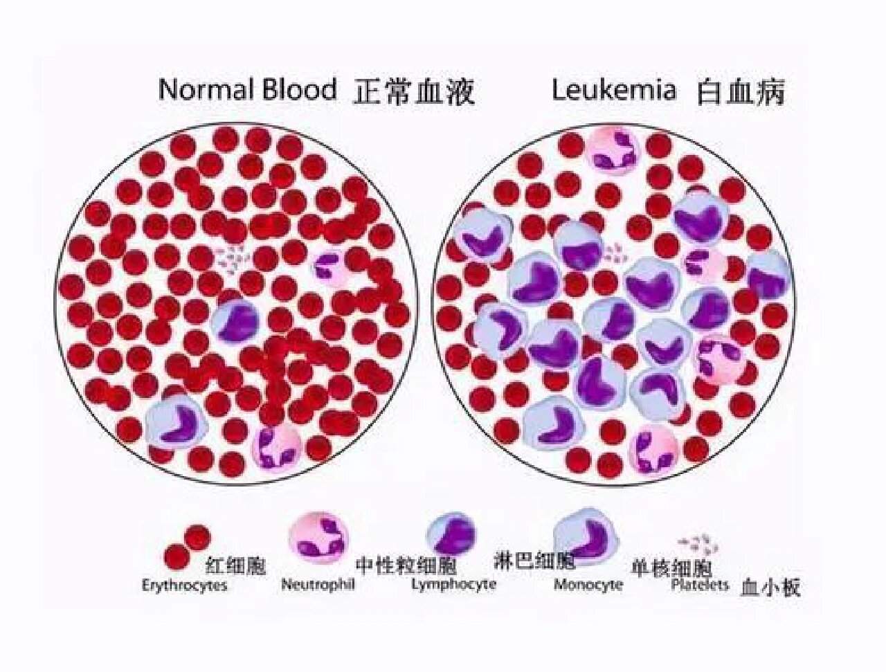 白血病怎么引起的图片